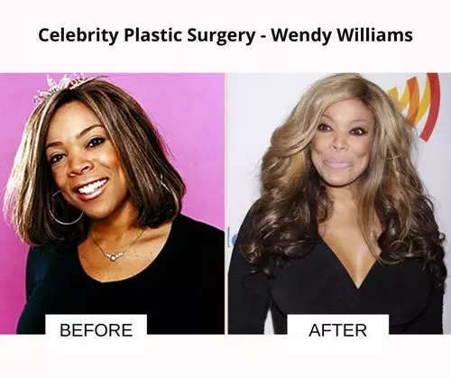 Wendy Williams  plastic surgery