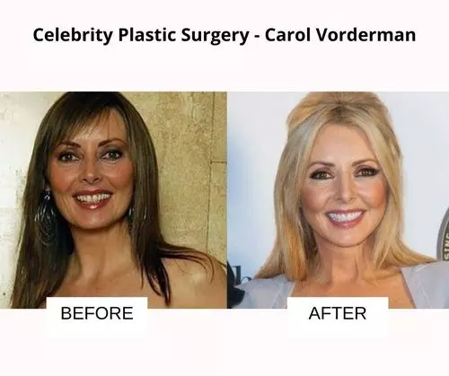 Carol Vorderman plastic surgery