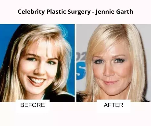 Jennie Garth plastic surgery
