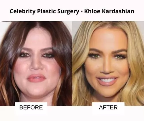 Khloe Kardashian plastic surgery