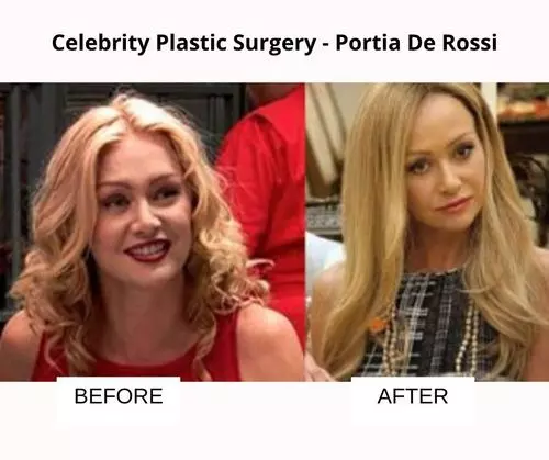 Portia De Rossi plastic surgery