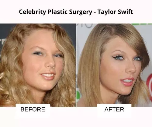 Taylor Swift plastic surgery