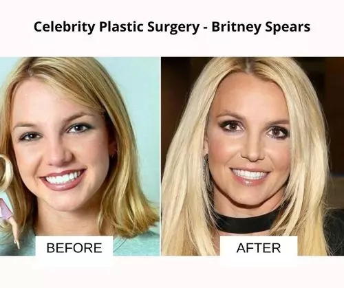 Britney Spears plastic surgery