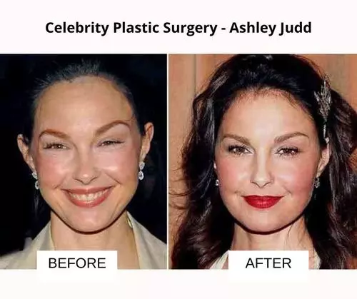 Ashley Judd plastic surgery