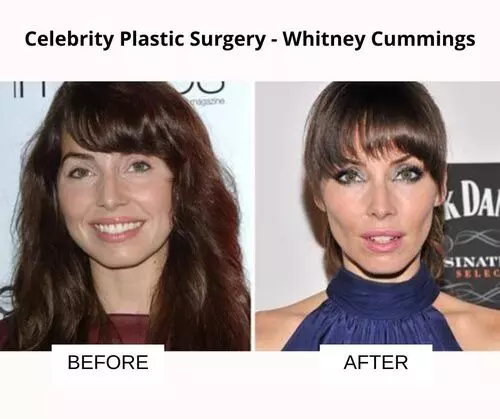 Whitney Cummings plastic surgery