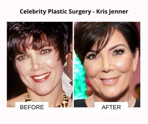 Kris Jenner plastic surgery