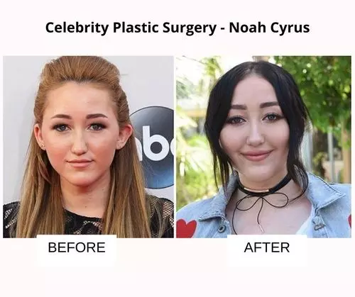_Noah Cyrus plastic surgery