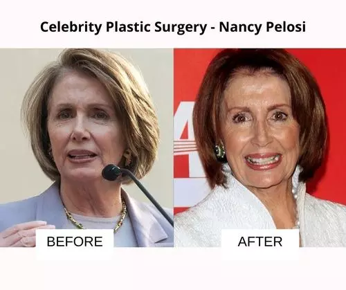 Nancy Pelosi plastic surgery