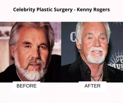 Kenny Rogers plastic surgery