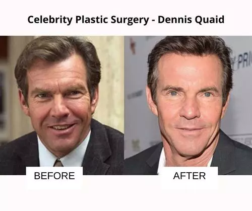 Dennis Quaid plastic surgery