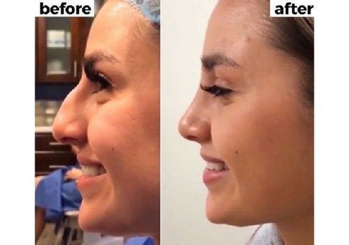 Nose_job_before_after