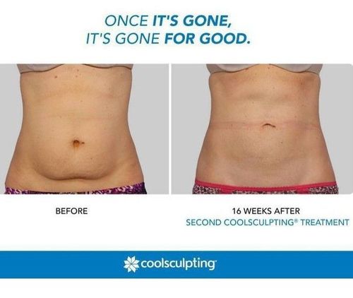 1 what is coolsculpting