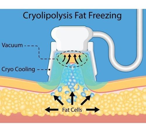 1 what is fat freezing