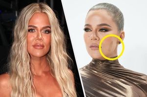 Khloe Kardashian Face Tumor