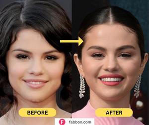 Did Selena Gomez Get Plastic Surgery ?